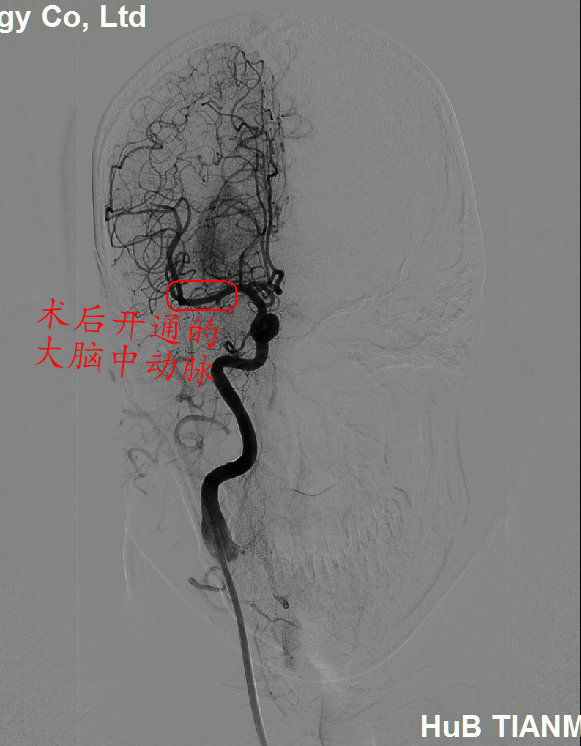 3术后造影显示右侧大脑中动脉完美再通.jpg